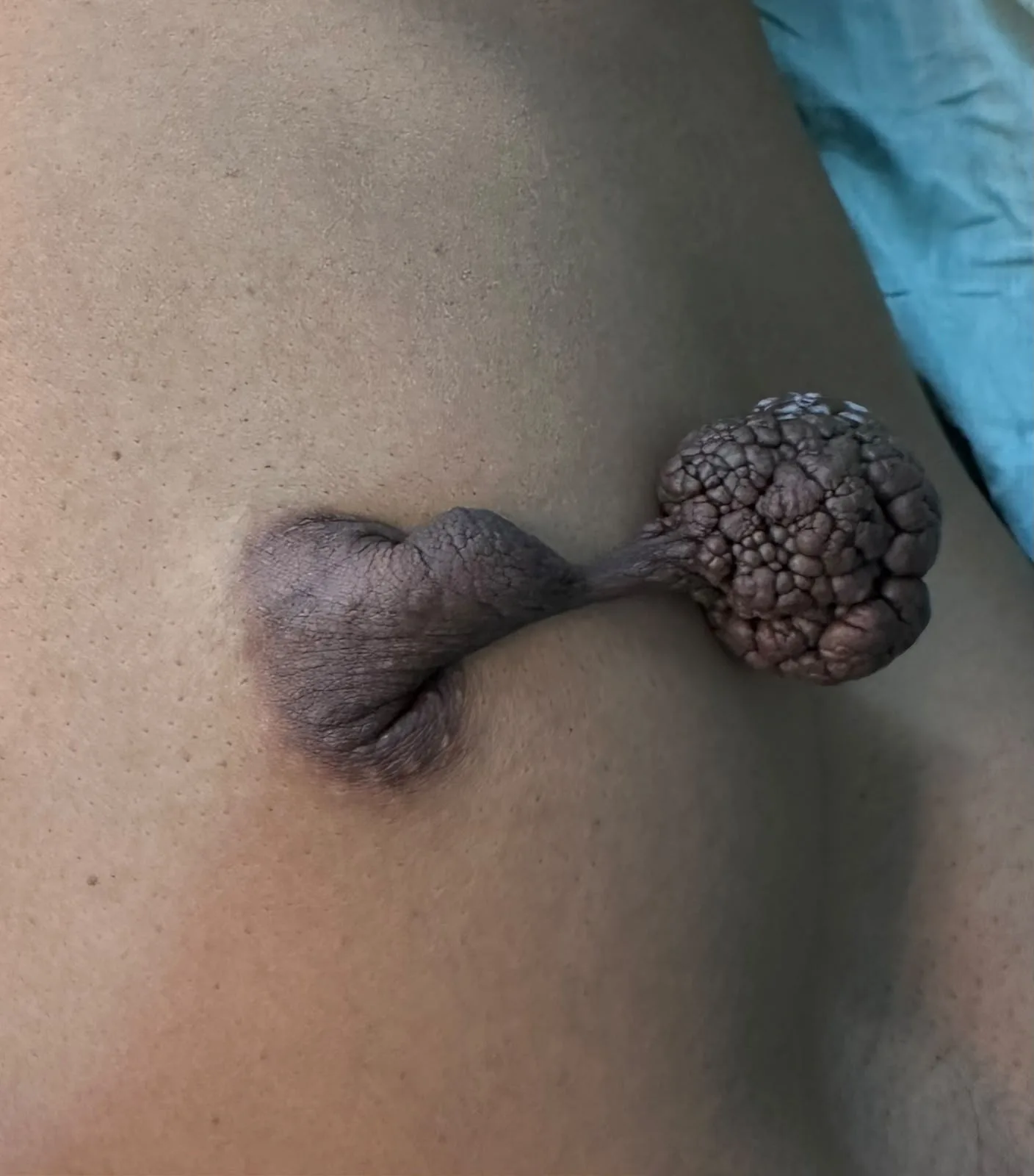 01 Skin Pedunculated Wart Like Growth Near Nipple Before Surgery