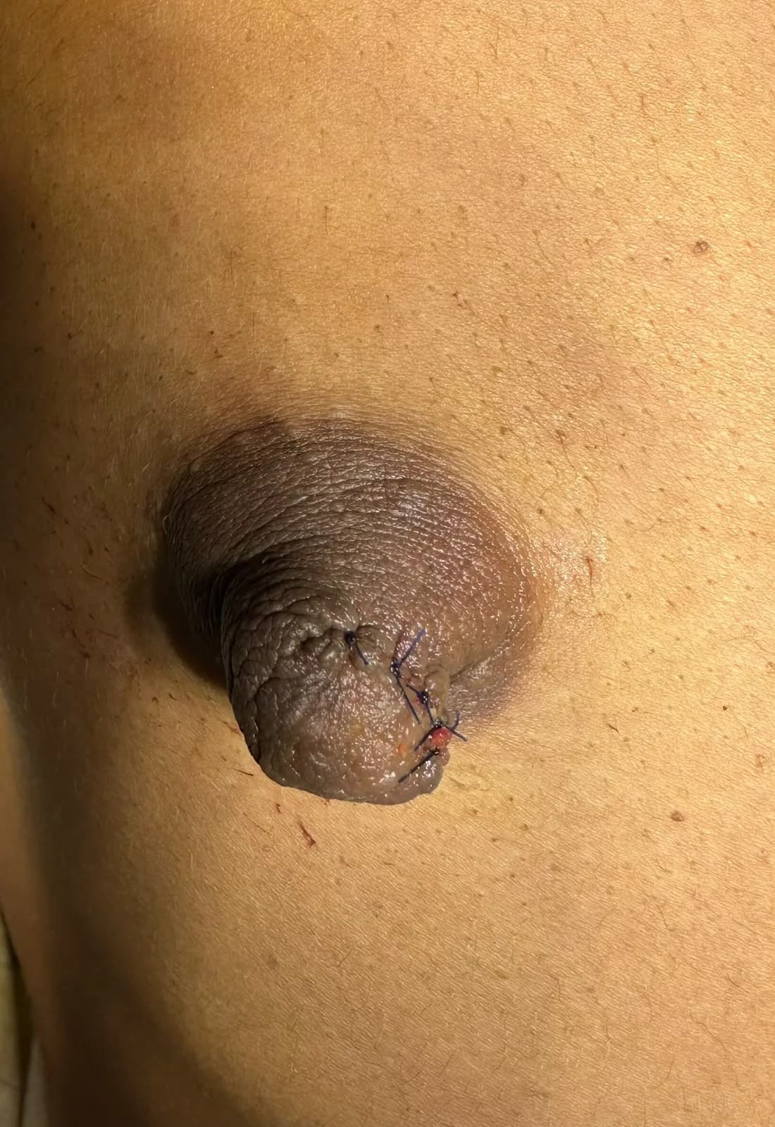 02 Skin Same Site After Excision Neatly Sutured