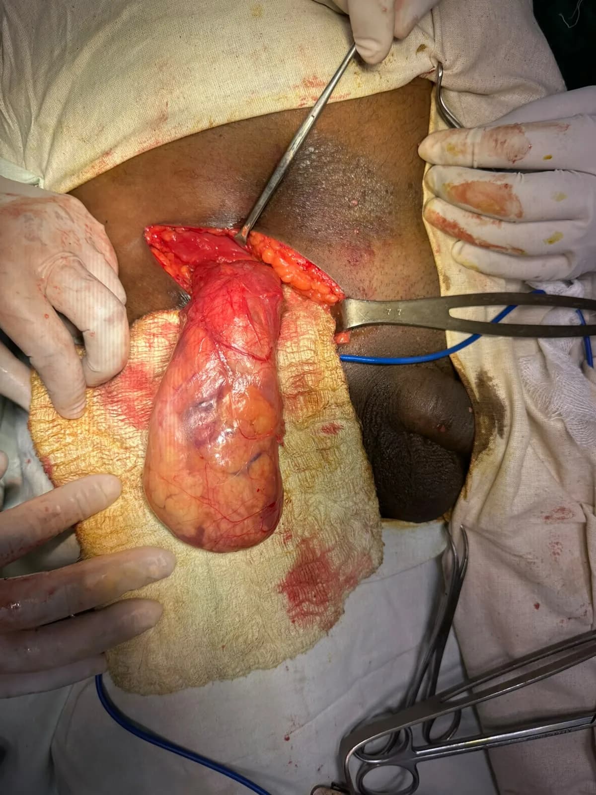 03 Hernia Open Inguinal Repair Sac Delivered Through Groin