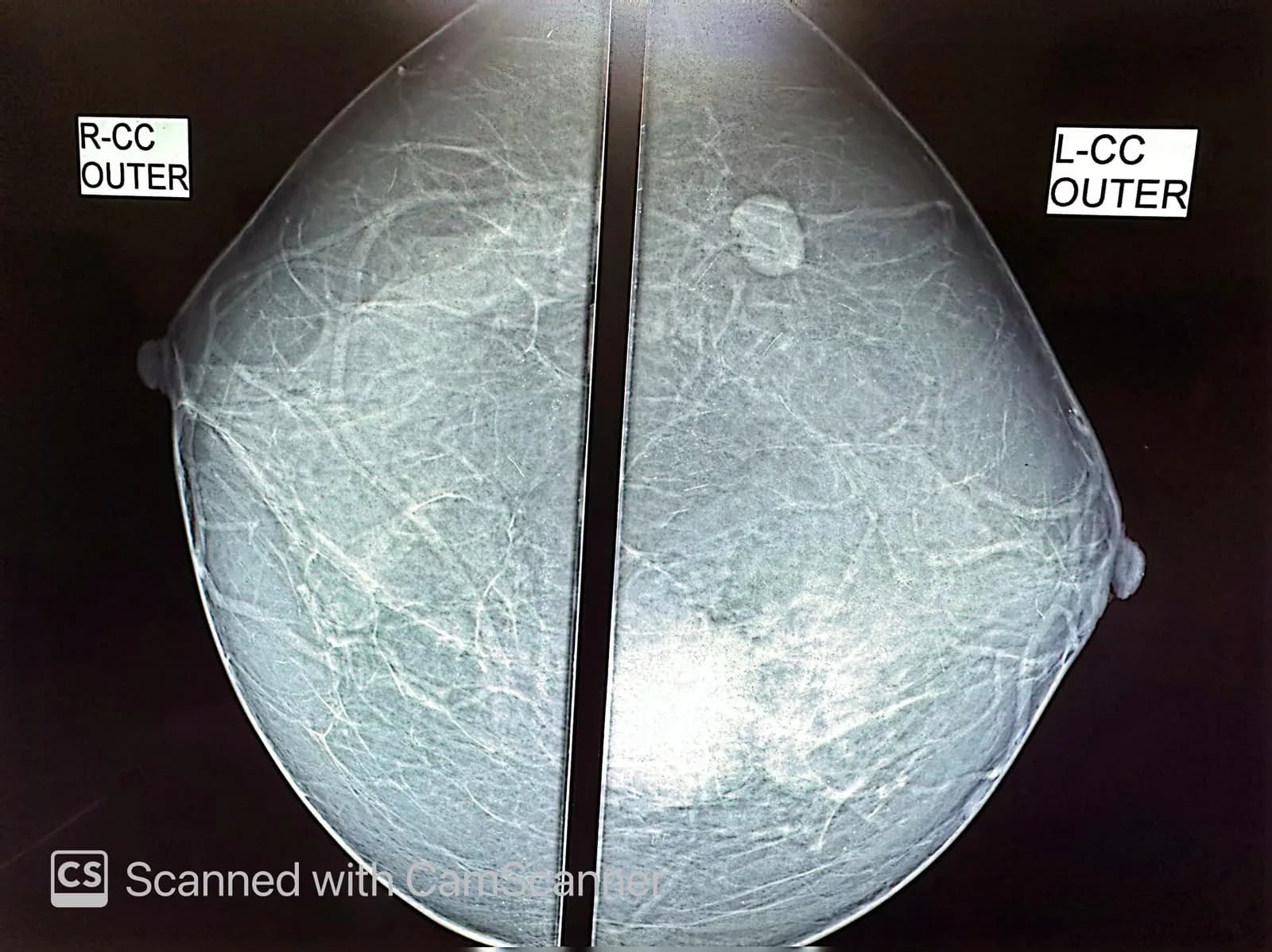 04 Imaging Mammogram Craniocaudal Views Both Breasts