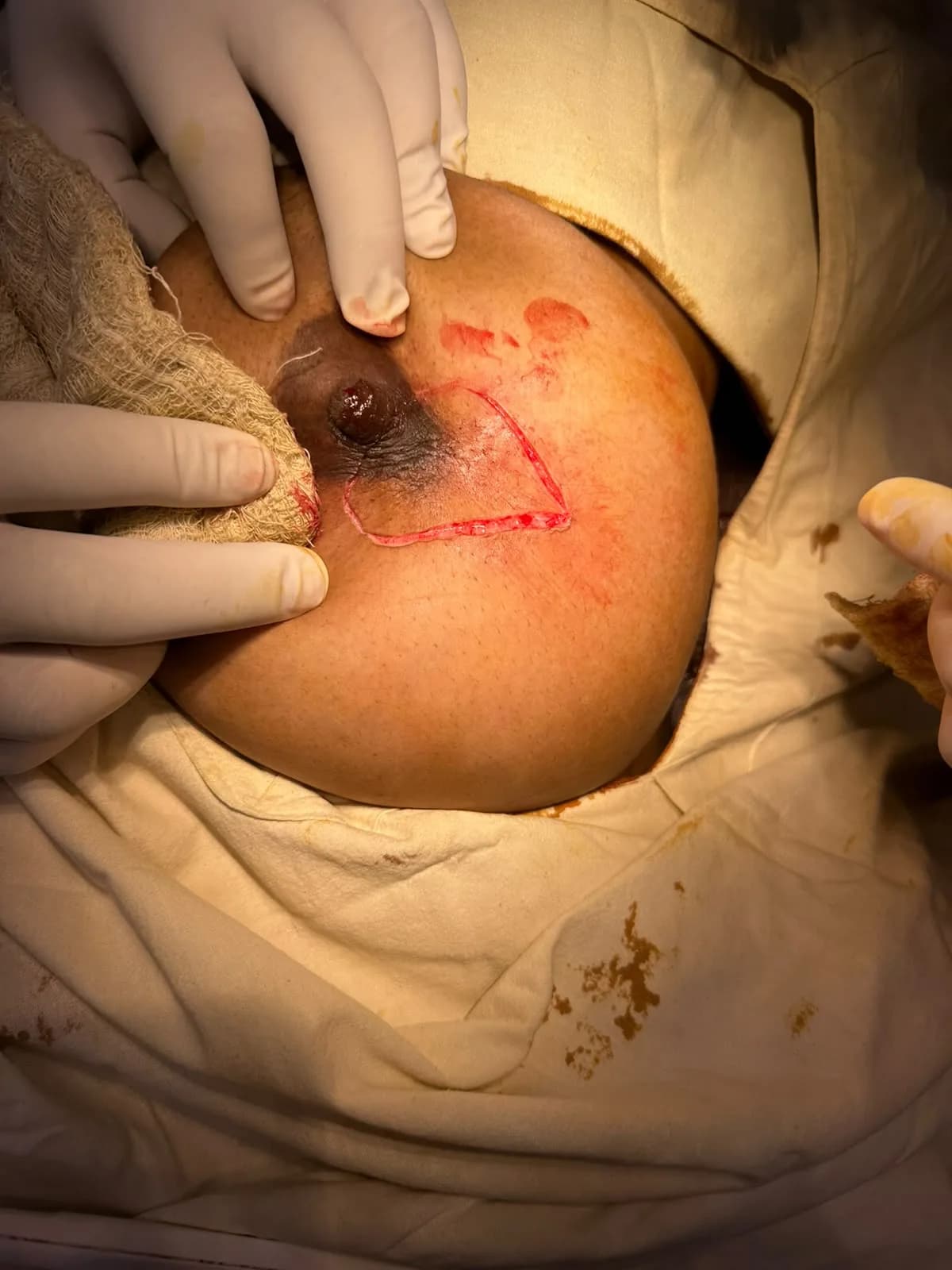 05 Breast Periareolar Incision Marked For Surgery