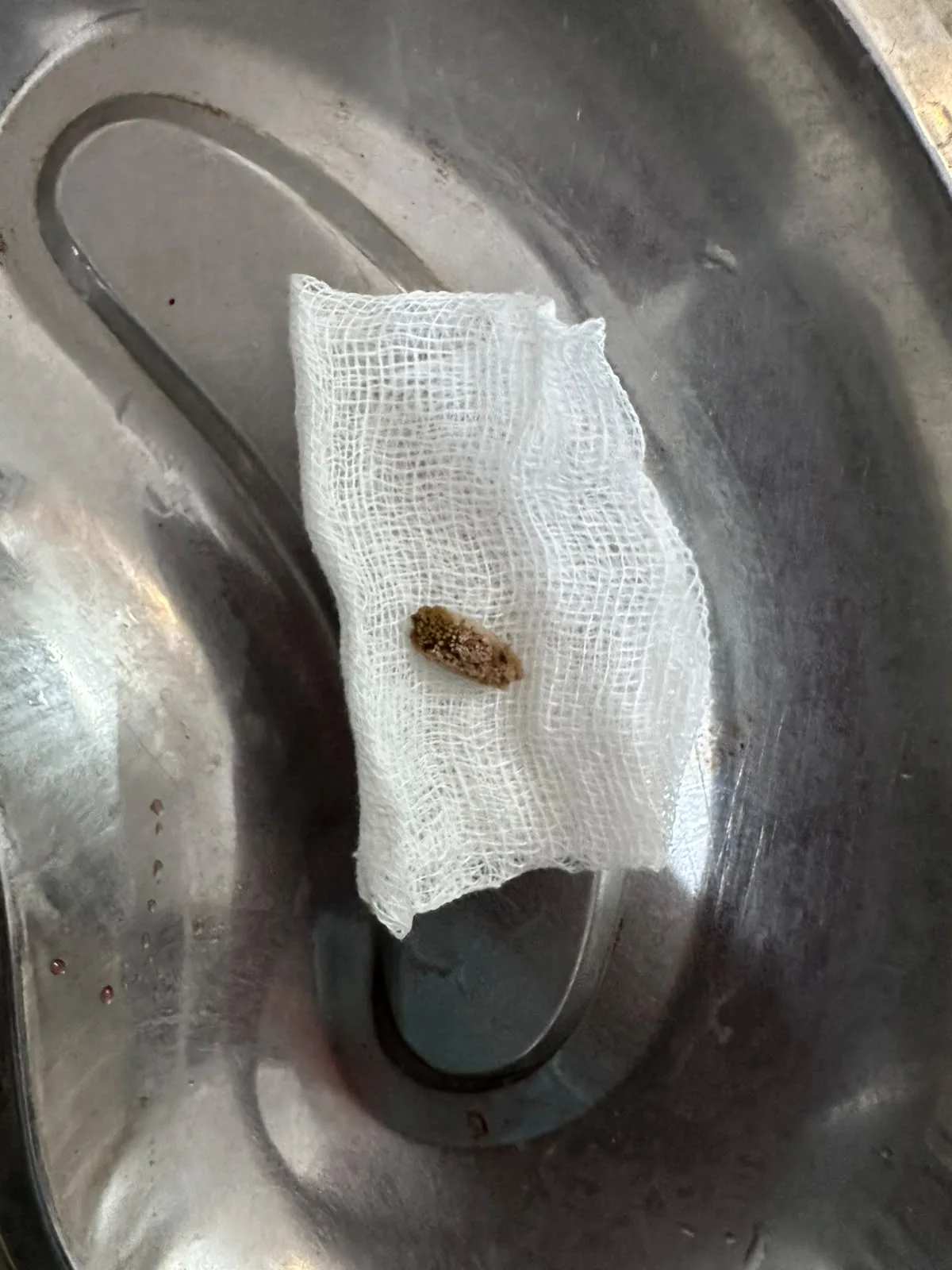 06 Specimen Small Removed Tissue On Gauze