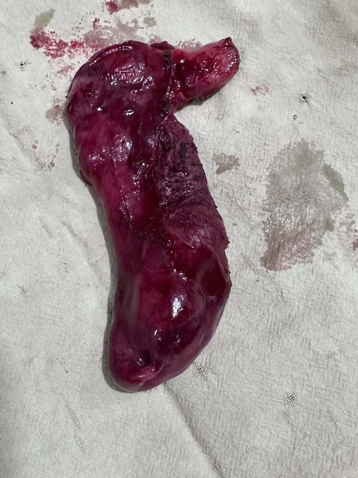 07 Appendix Inflamed Appendix Specimen After Surgery